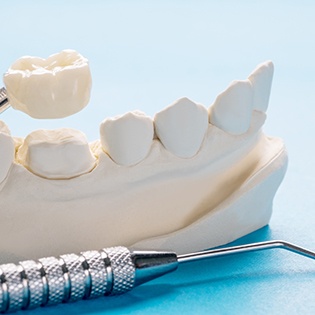 Dental crown being placed on model tooth