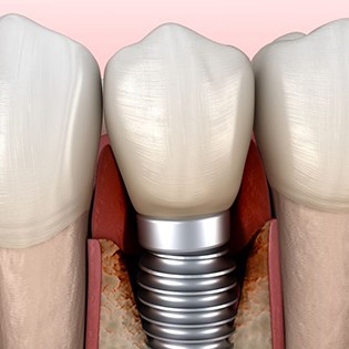 Close-up illustration of dental implant surrounded by infected tissue