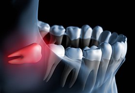 A 3D illustration of an impacted wisdom tooth